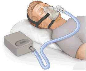 什麼是 CPAP 治療？